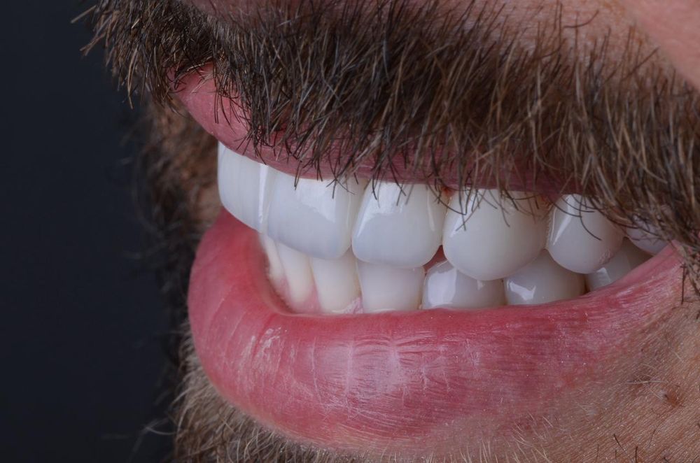 Resultado de lente de contato dental, sorriso feminino