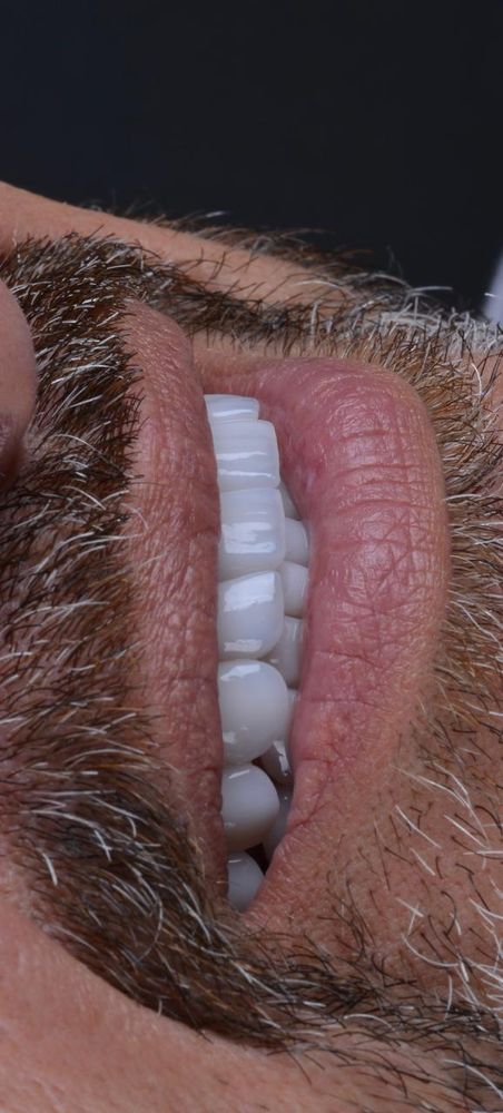 Detalhe de sorriso com facetas
