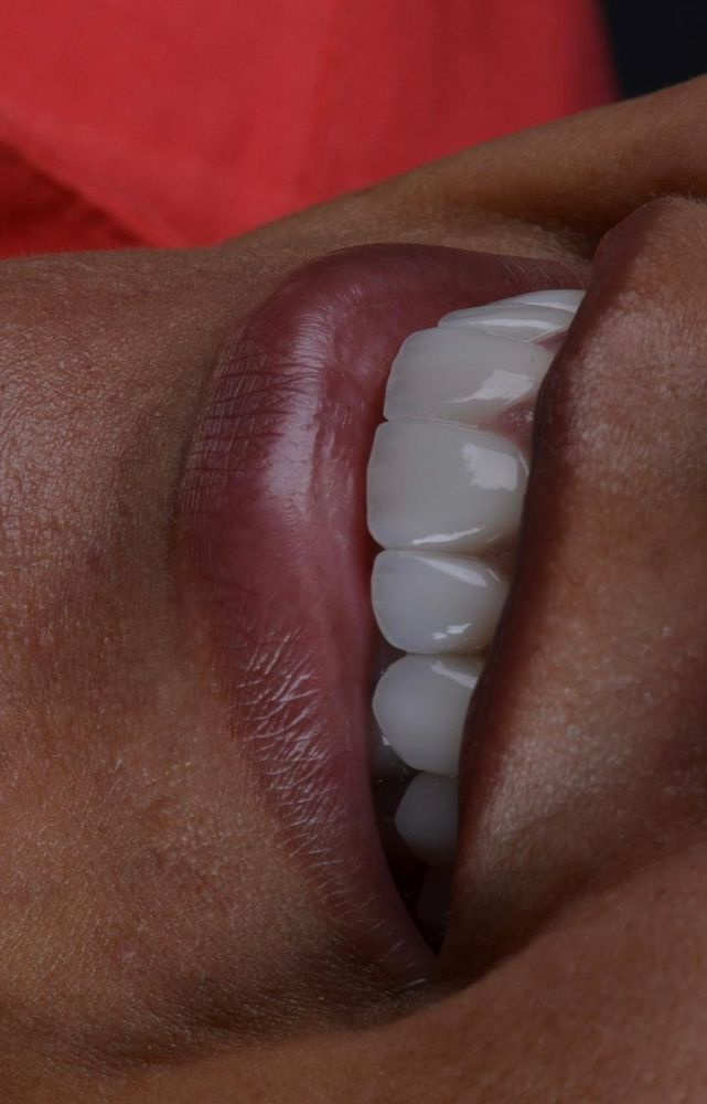 Sorriso com lentes, vista lateral
