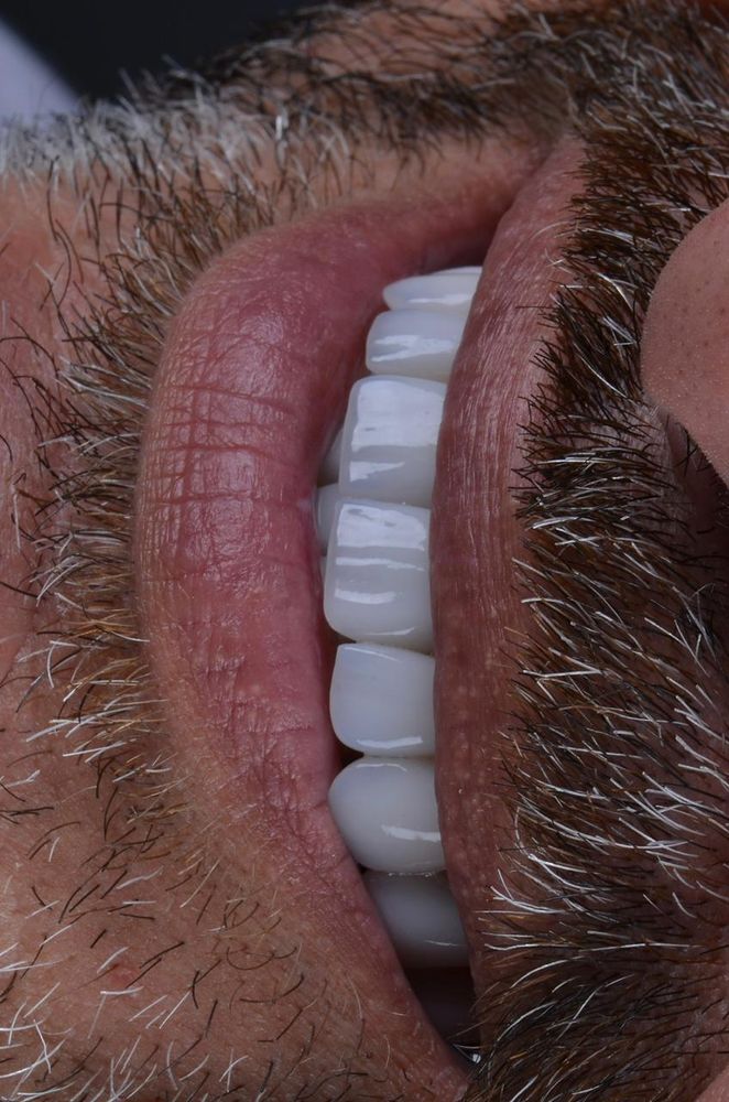 Sorriso reabilitado, vista frontal