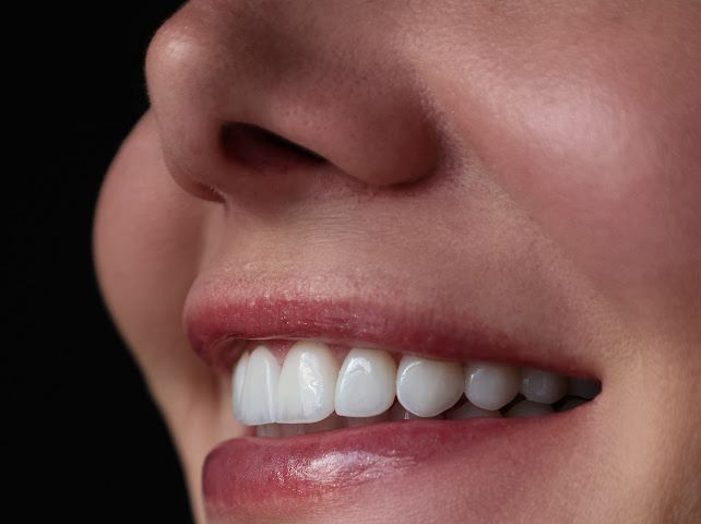 Sorriso com acabamento natural