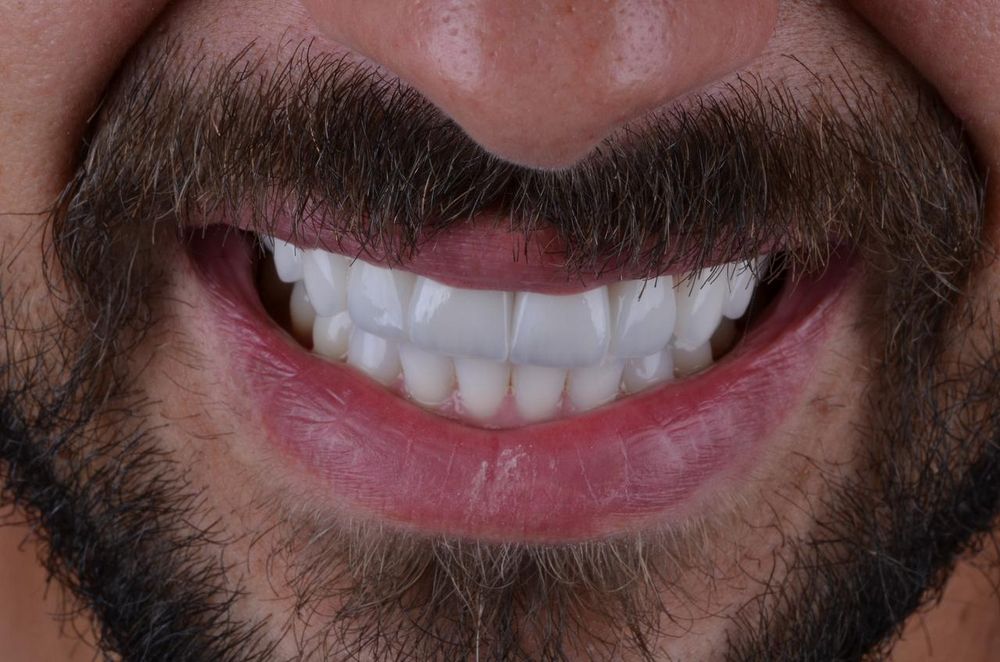 Resultado de reabilitação estética do sorriso