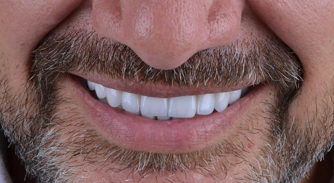 Implante dentário na Ambrózio Odontologia, Anápolis