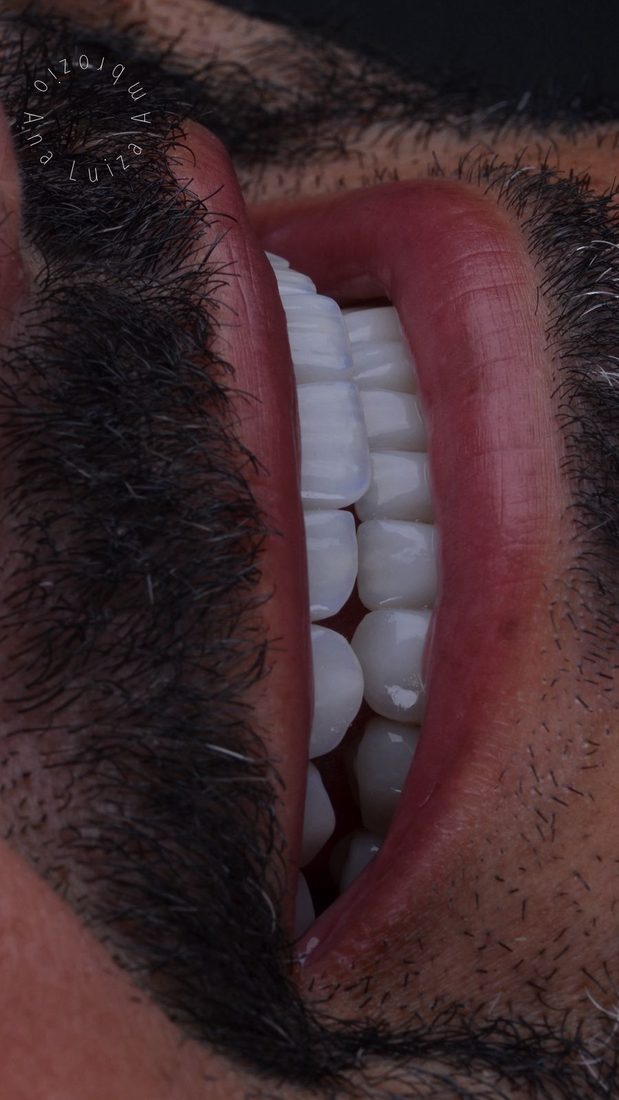 Reabilitação oral na Ambrózio Odontologia, Anápolis